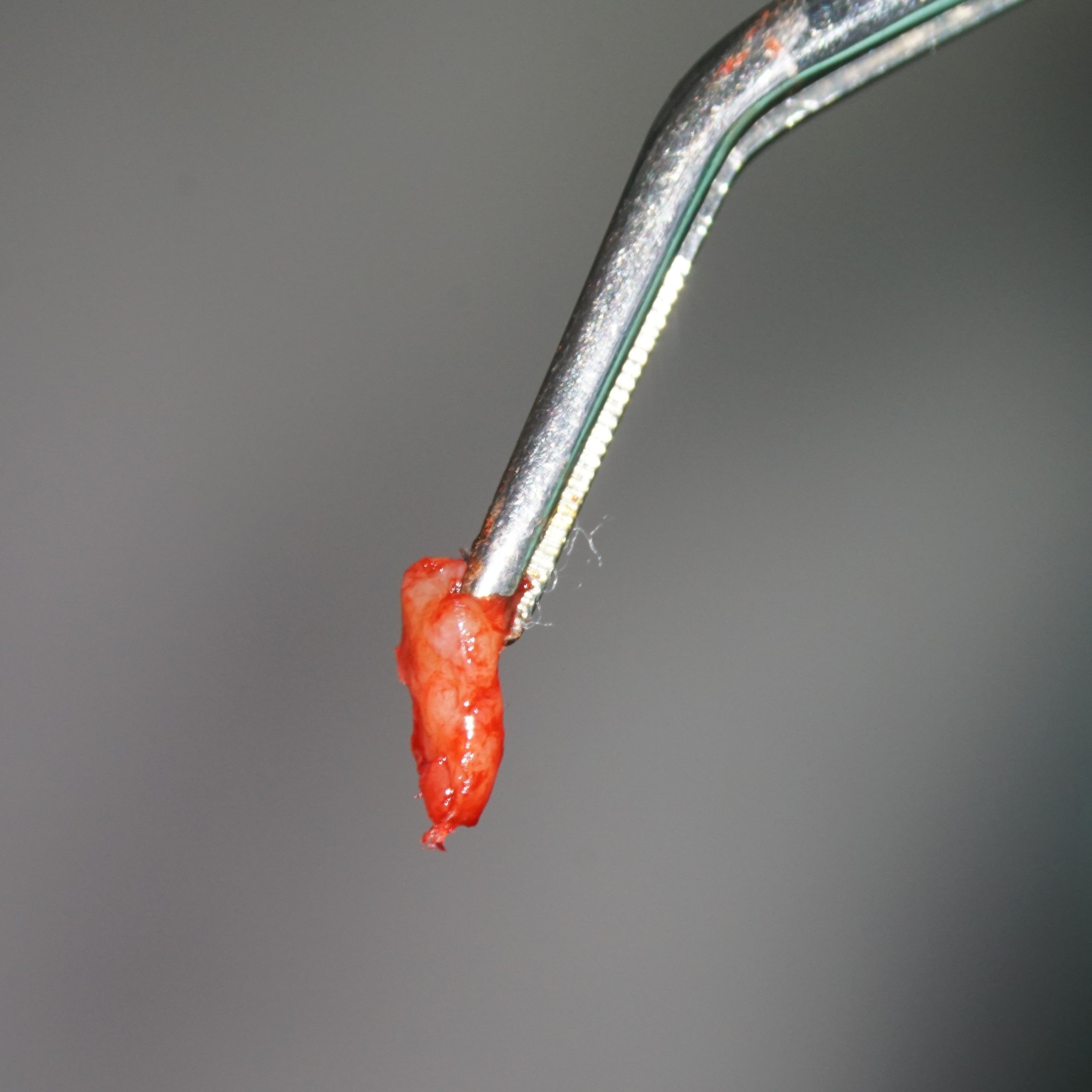 La chirurgie endodontique du secteur antérieur en omnipratique