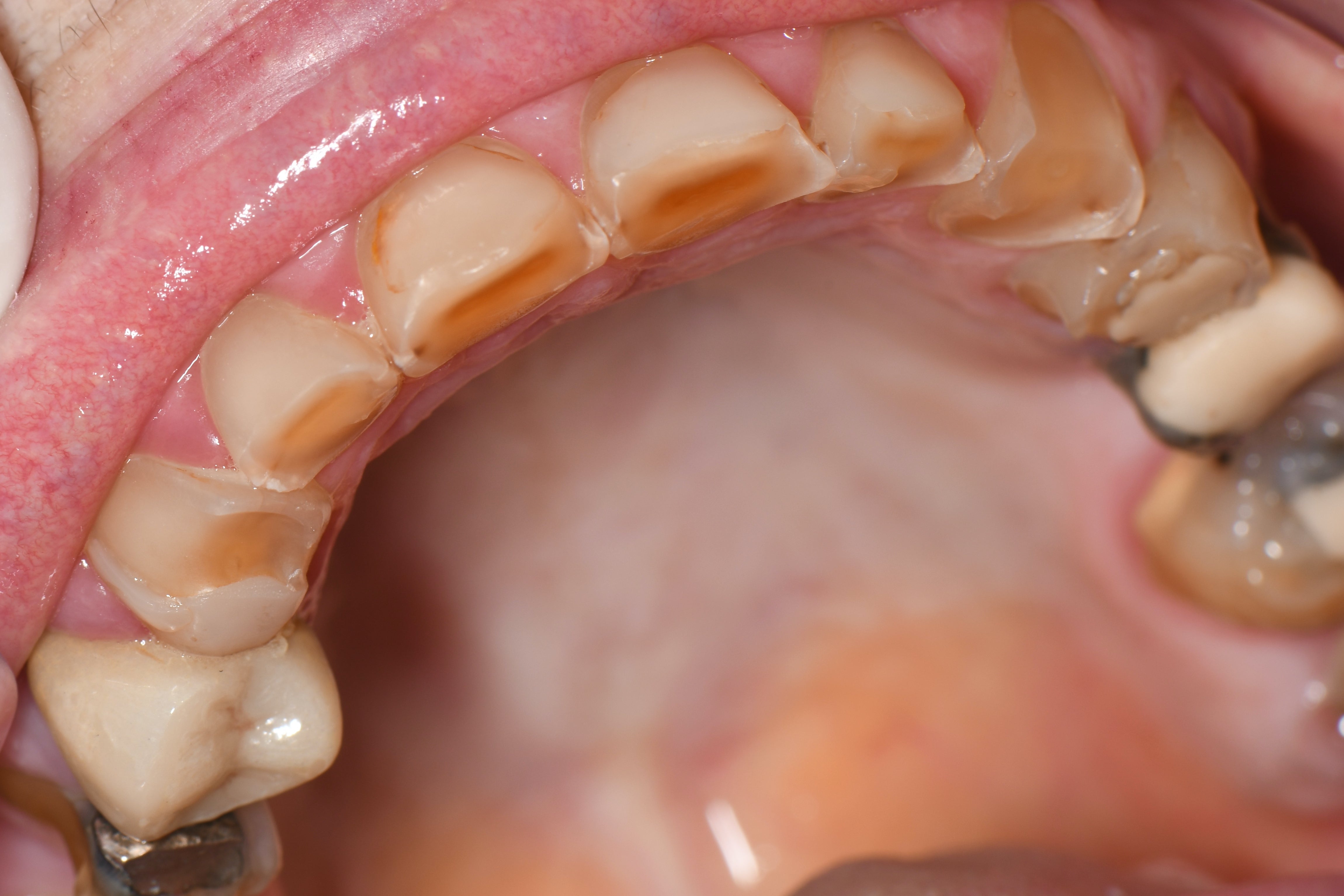 Occlusodontie