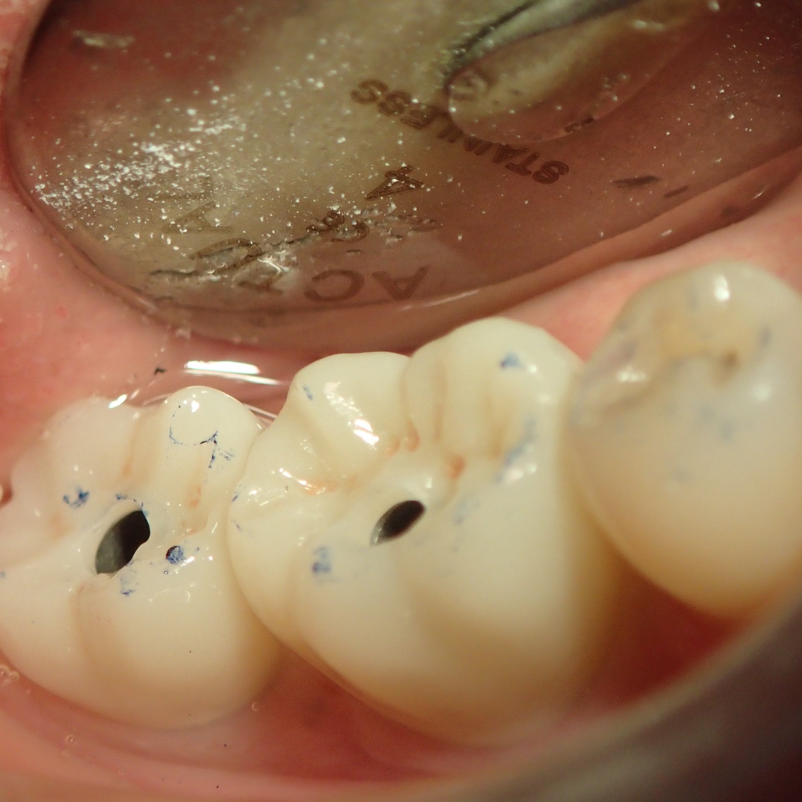 Occlusodontie