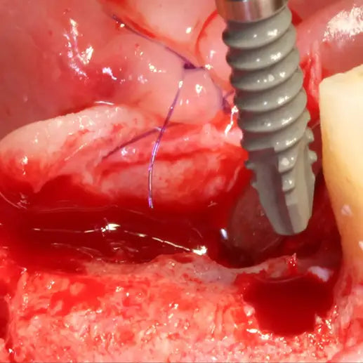 Formation ROG en implantologie avancée - Clinicall