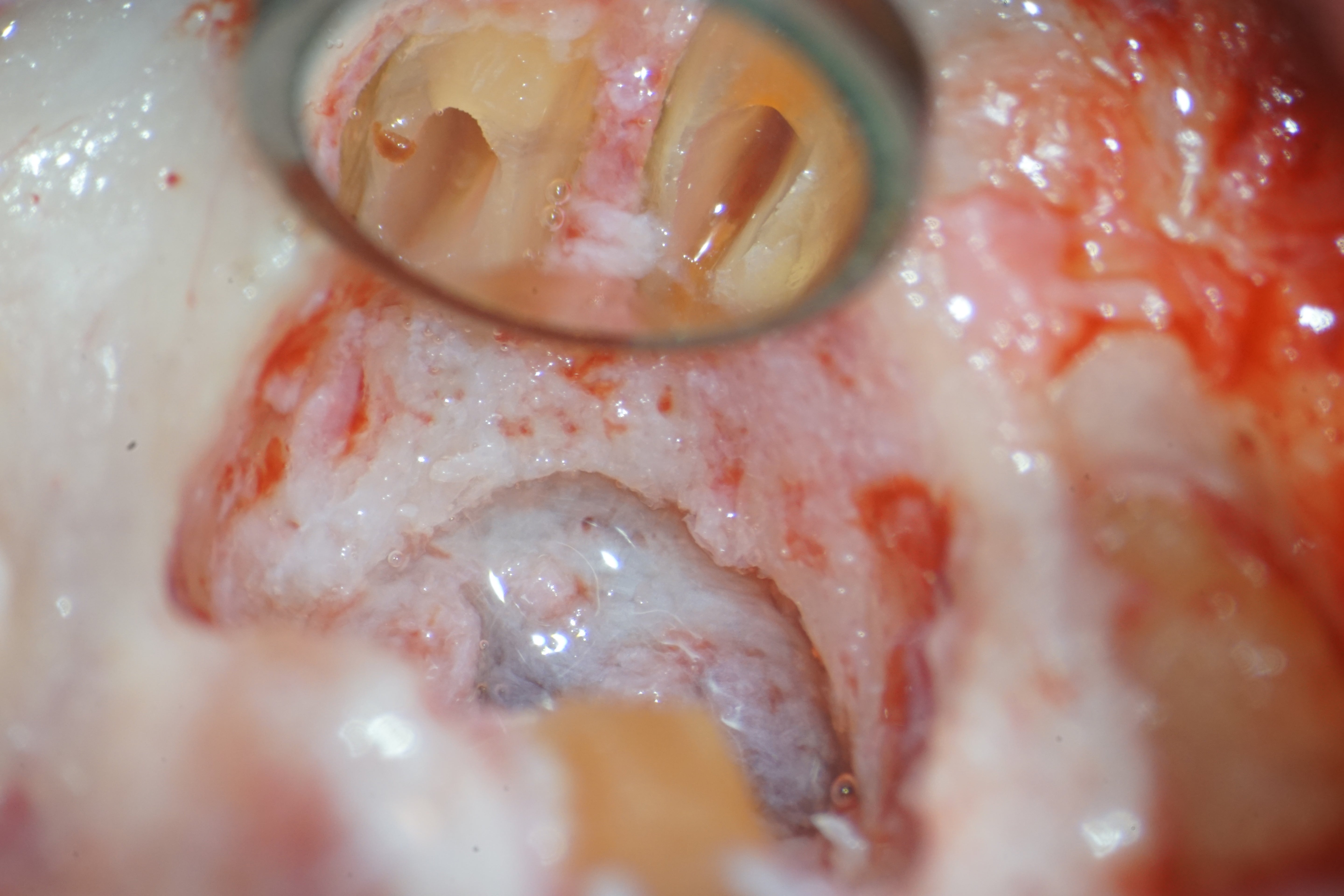 La chirurgie endodontique du secteur antérieur en omnipratique