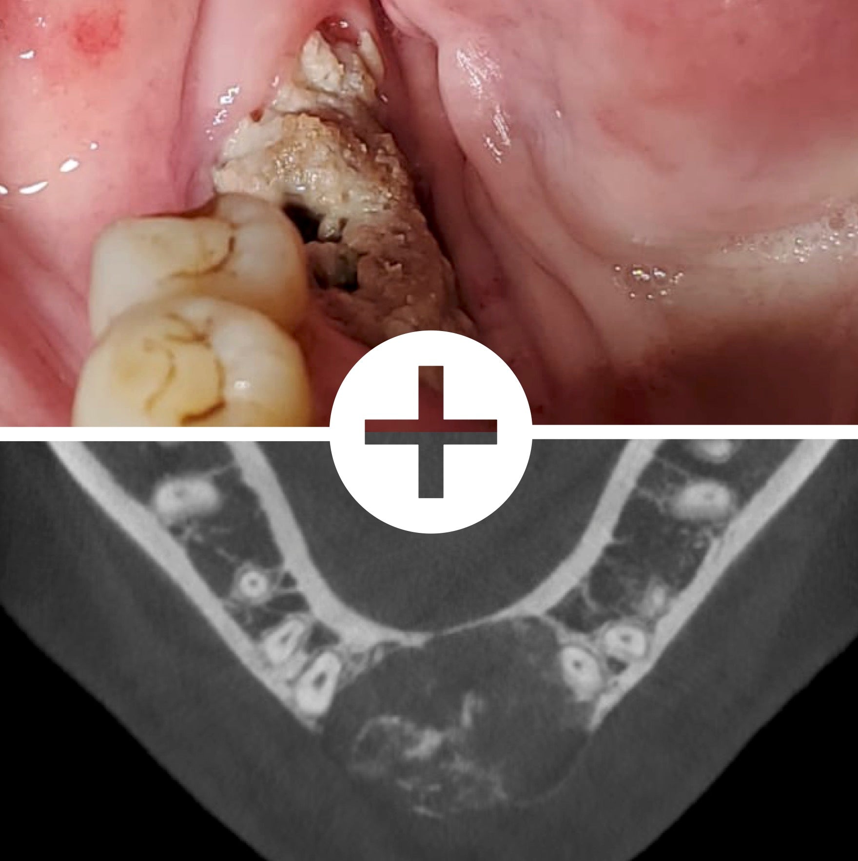 Les lésions osseuses et la prise en charge des patients sous traitement anti-cancéreux