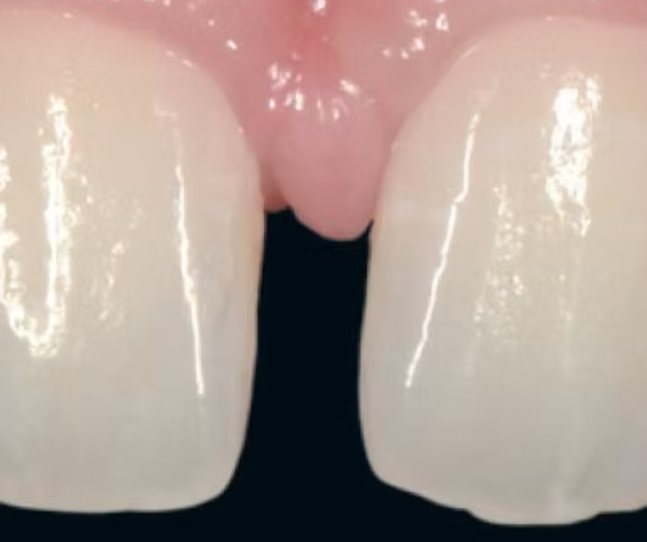 Restaurations indirectes en composites : la technique pressée