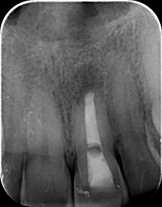 La chirurgie endodontique du secteur antérieur en omnipratique