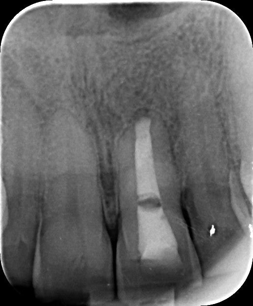 La chirurgie endodontique du secteur antérieur en omnipratique