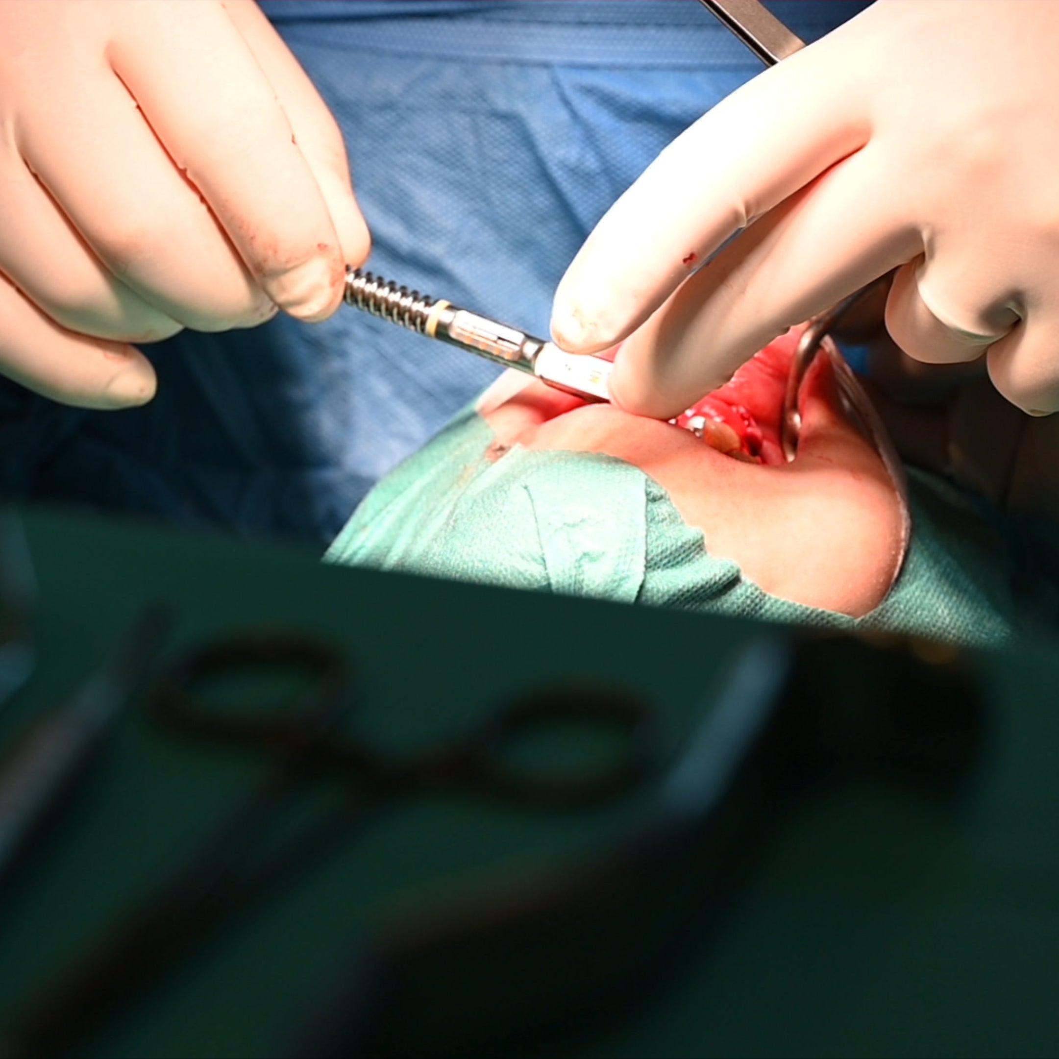 Chirurgie orale