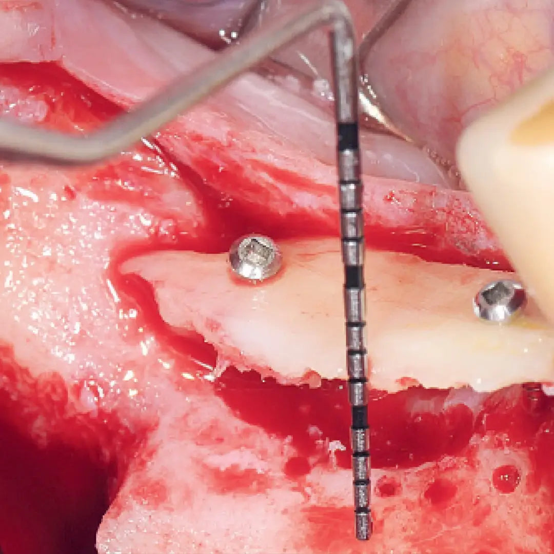 Formation greffes osseuses en implantologie avancée - Clinicall
