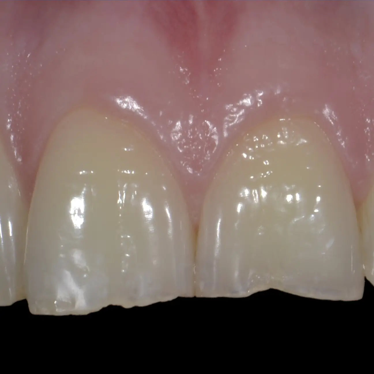 Formation Usures et Érosions Dentaires - Clinicall