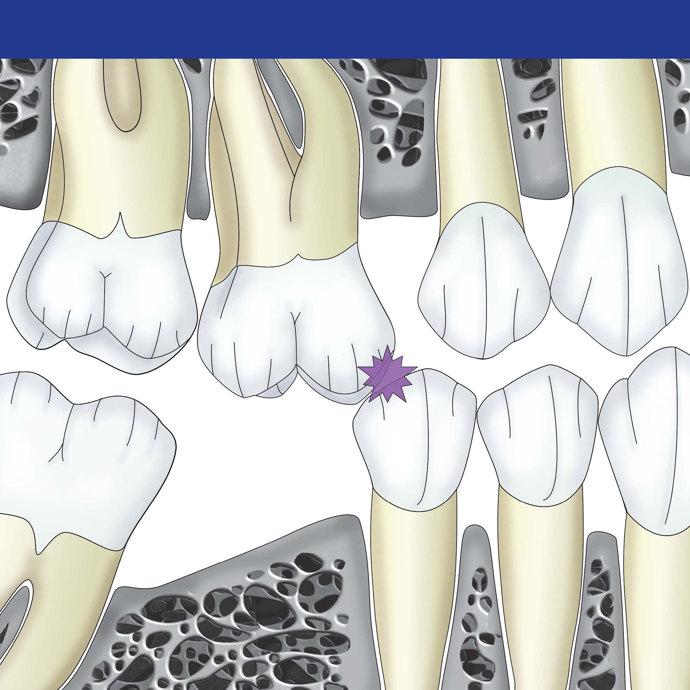 Occlusodontie
