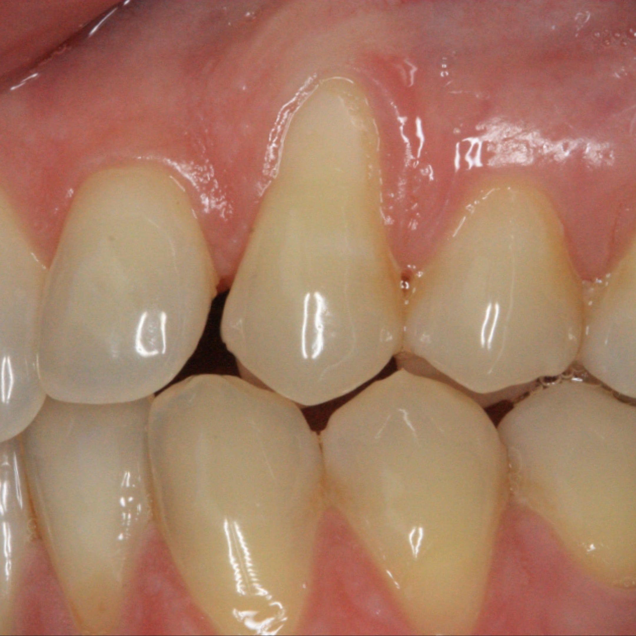 La chirurgie muco-gingivale