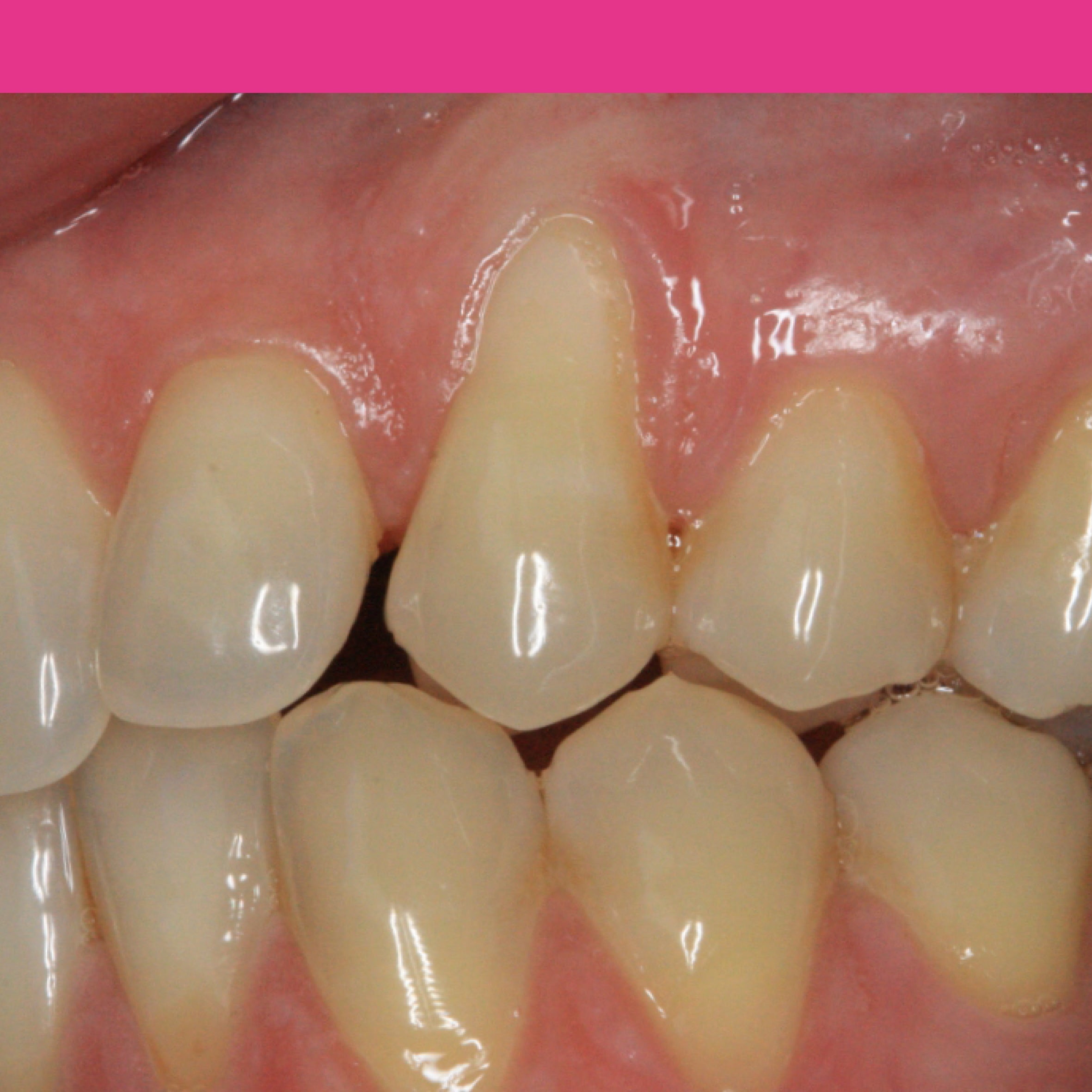 La chirurgie muco-gingivale