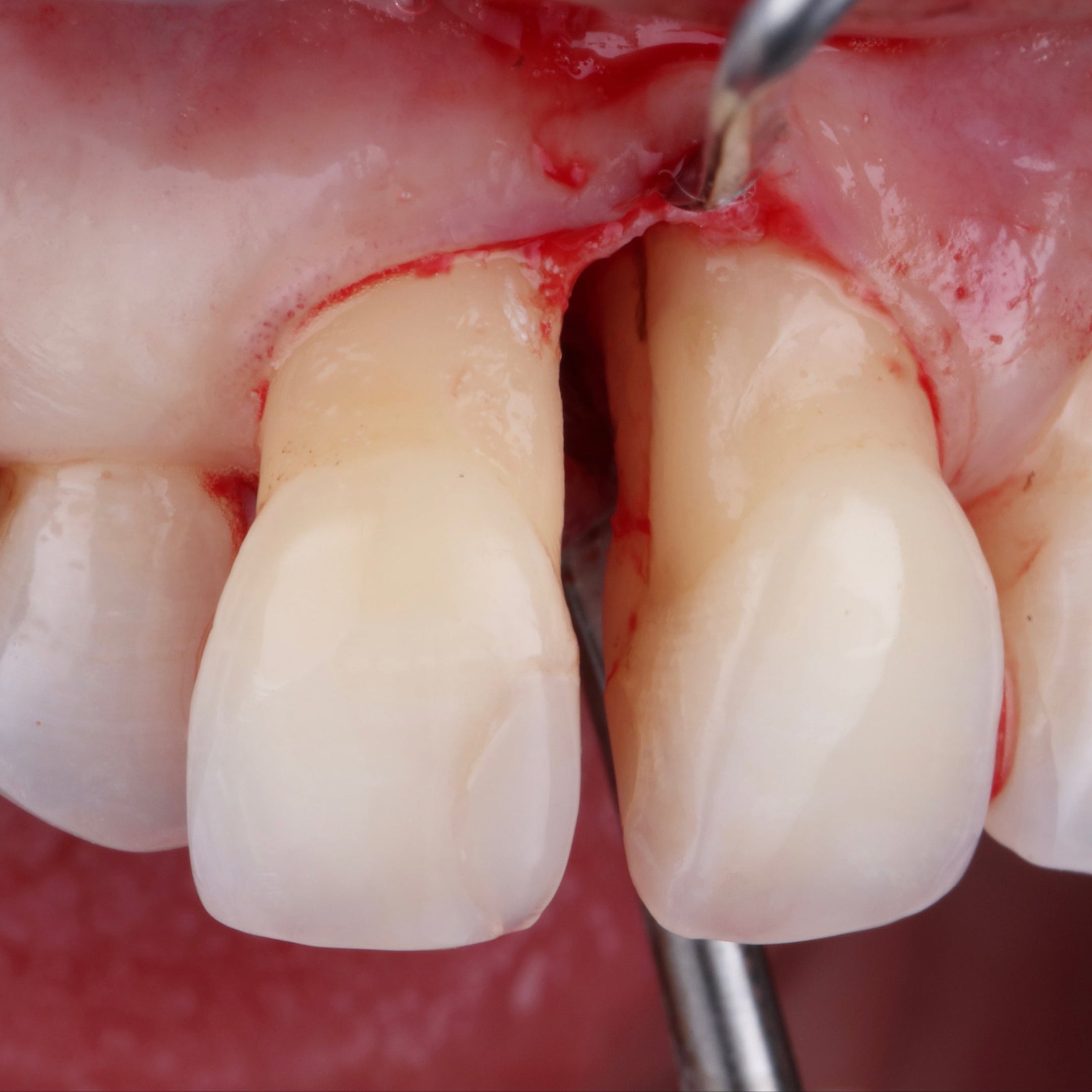 Le traitement non chirurgical en parodontologie