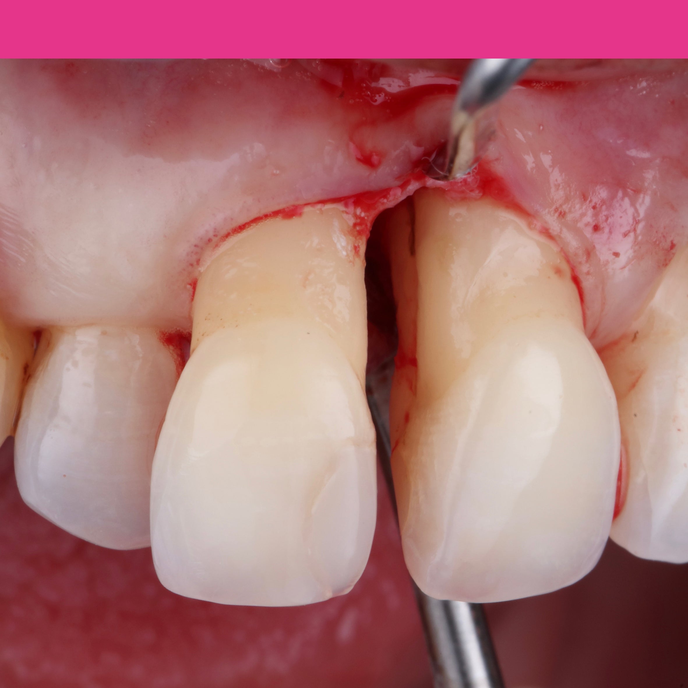 Le traitement non chirurgical en parodontologie