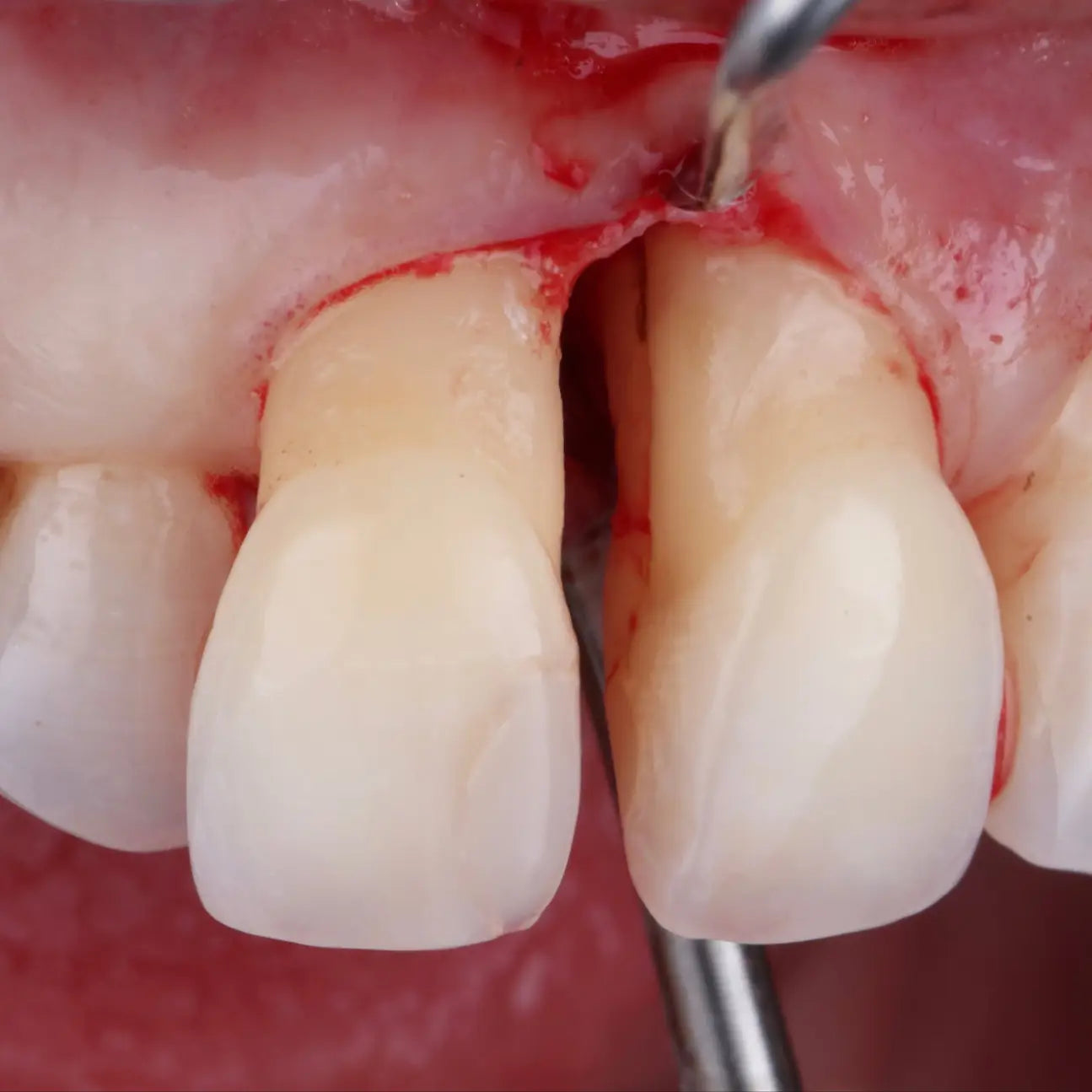 Formation Traitement Non Chirurgical en Parodontologie