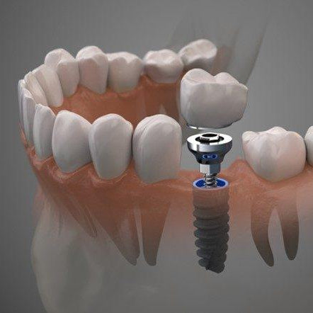 formation clinic-all prothese implantaire