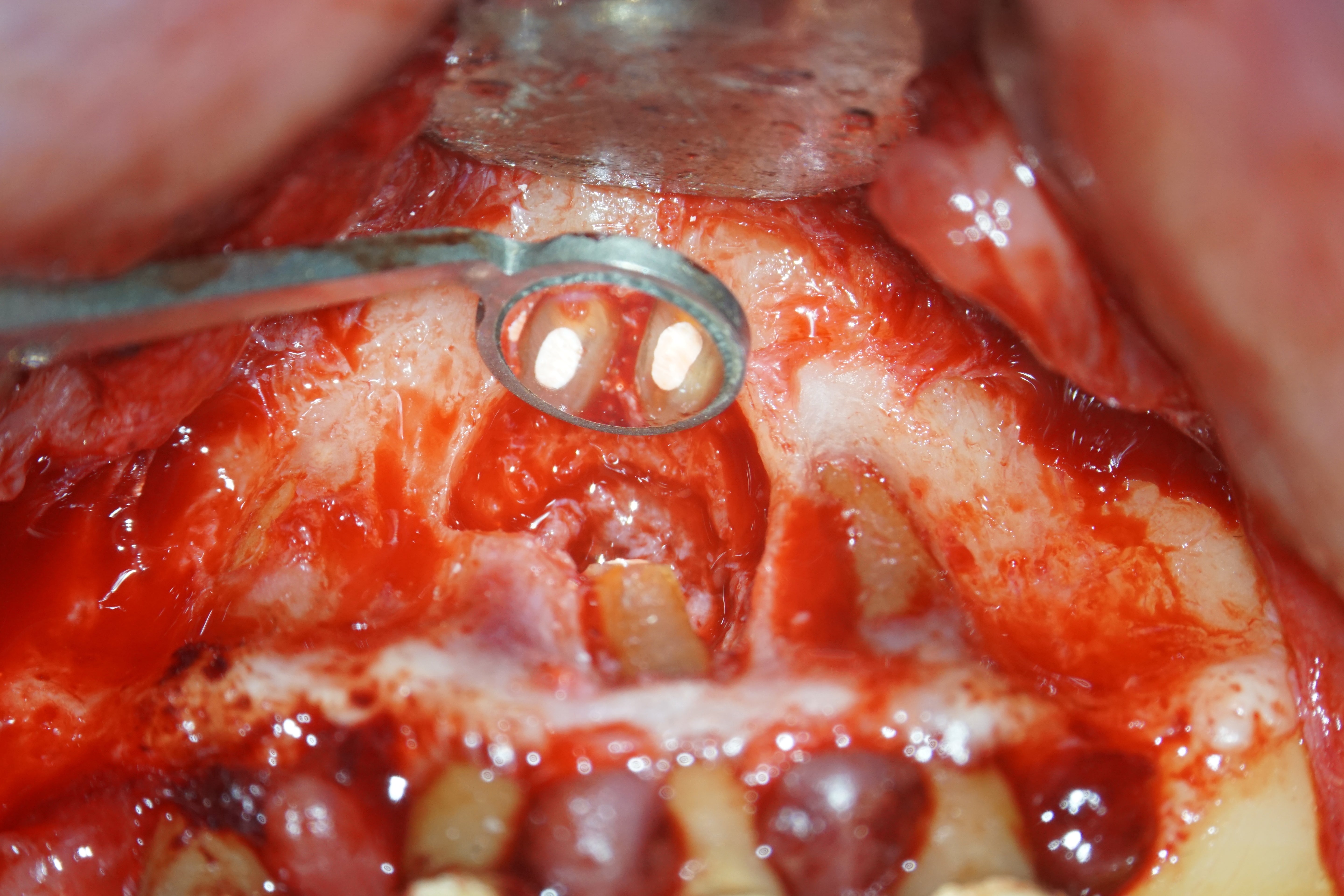La chirurgie endodontique du secteur antérieur en omnipratique